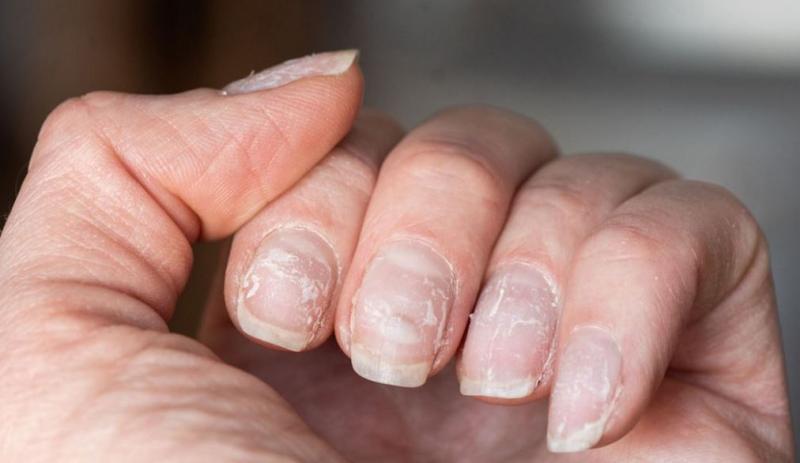 नाखून हमारे शरीर की आंतरिक सेहत का संकेत : आयुर्वेद नाखून हमारे शरीर की आंतरिक सेहत का संकेत : आयुर्वेद